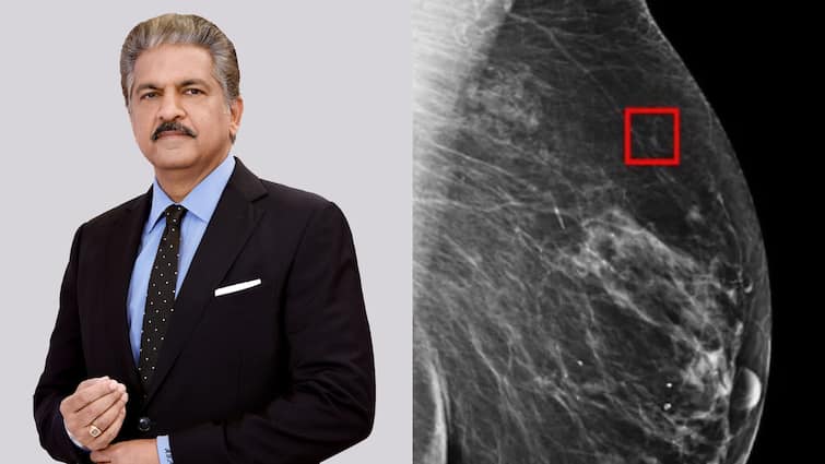 Cancer can be detected 5 years before it develops says Anand Mahindra on AI X Post