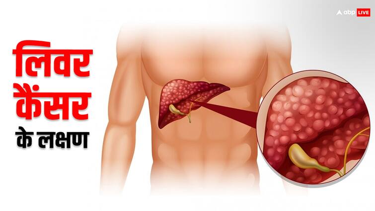 Risks and causes of liver cancer​​ Liver cancer is uncommon in the UK