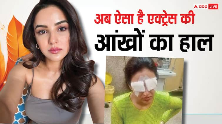 bigg boss fame jasmin bhasin show her eyes on Camera After Corneal Injury